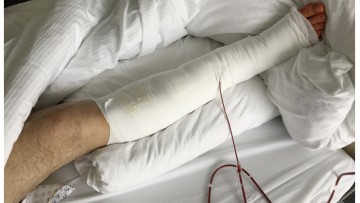 GDV: Kfz-Versicherer und Unfallchirurgen wollen Reha-Lücke schließen